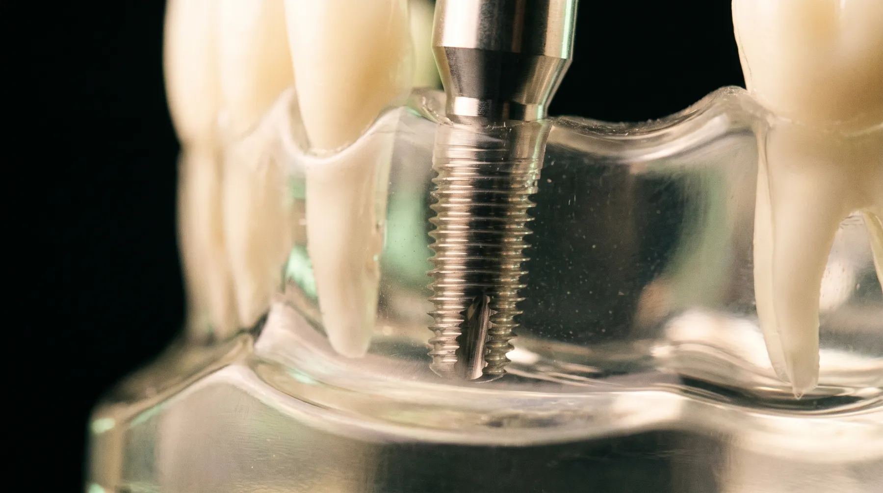 Implant vissé dans l'os entre deux dents, sur un modèle transparent