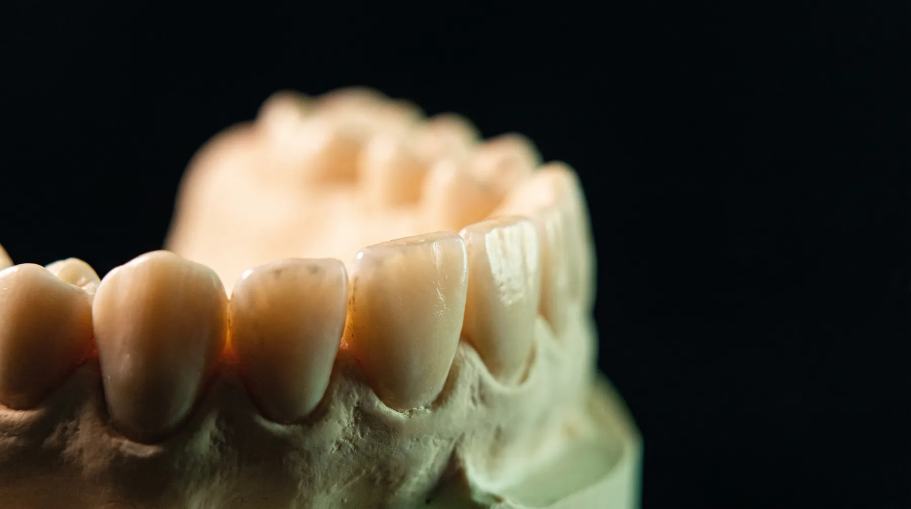 Arcade dont les dents présentent des bords usés et aplatis